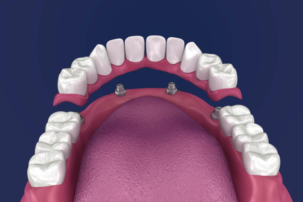 Dental Implant | Dillon, CO | Summit Dental Group