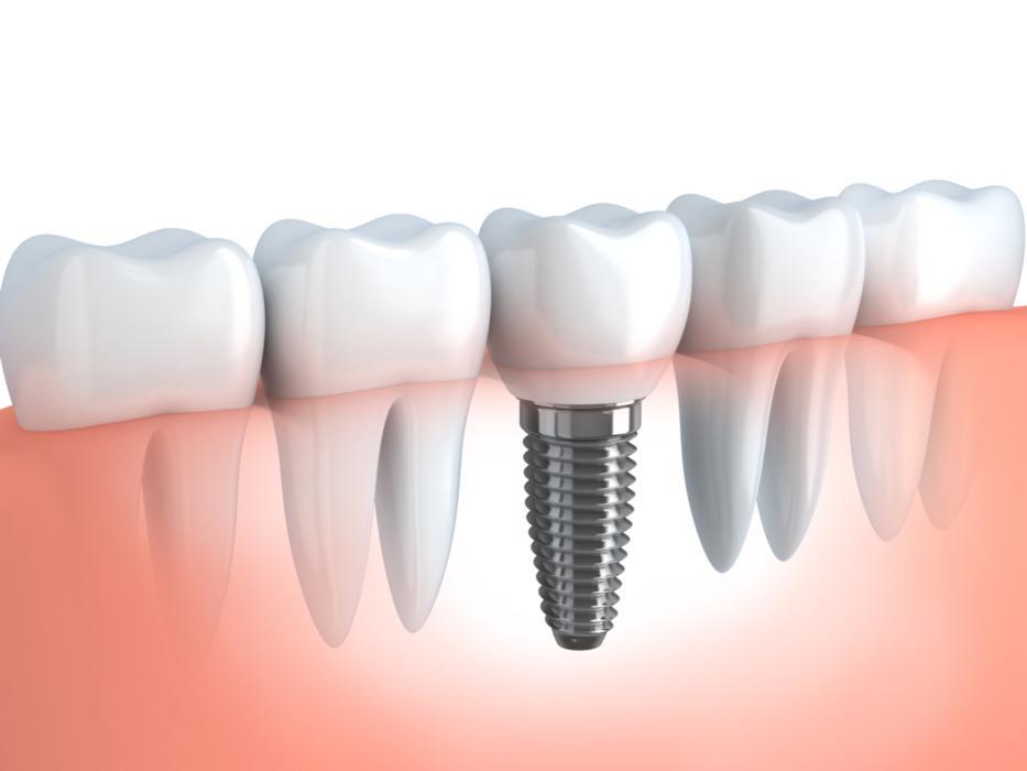 Diagram showing how to replace missing teeth with dental implants in Dillon, CO